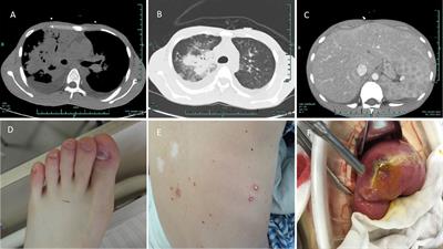 Case Report: Disseminated Talaromyces marneffei Infection in a Patient With Chronic Mucocutaneous Candidiasis and a Novel STAT1 Gain-of-Function Mutation